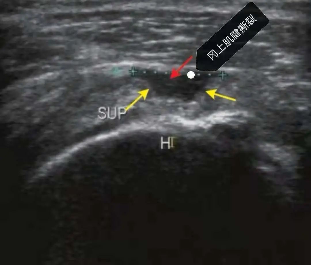 手麻肌电图检查过程视频,手麻脚麻肌电图正常