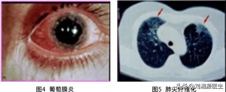 免疫相关不良妊娠诊断指南,免疫治疗不良妊娠的方法