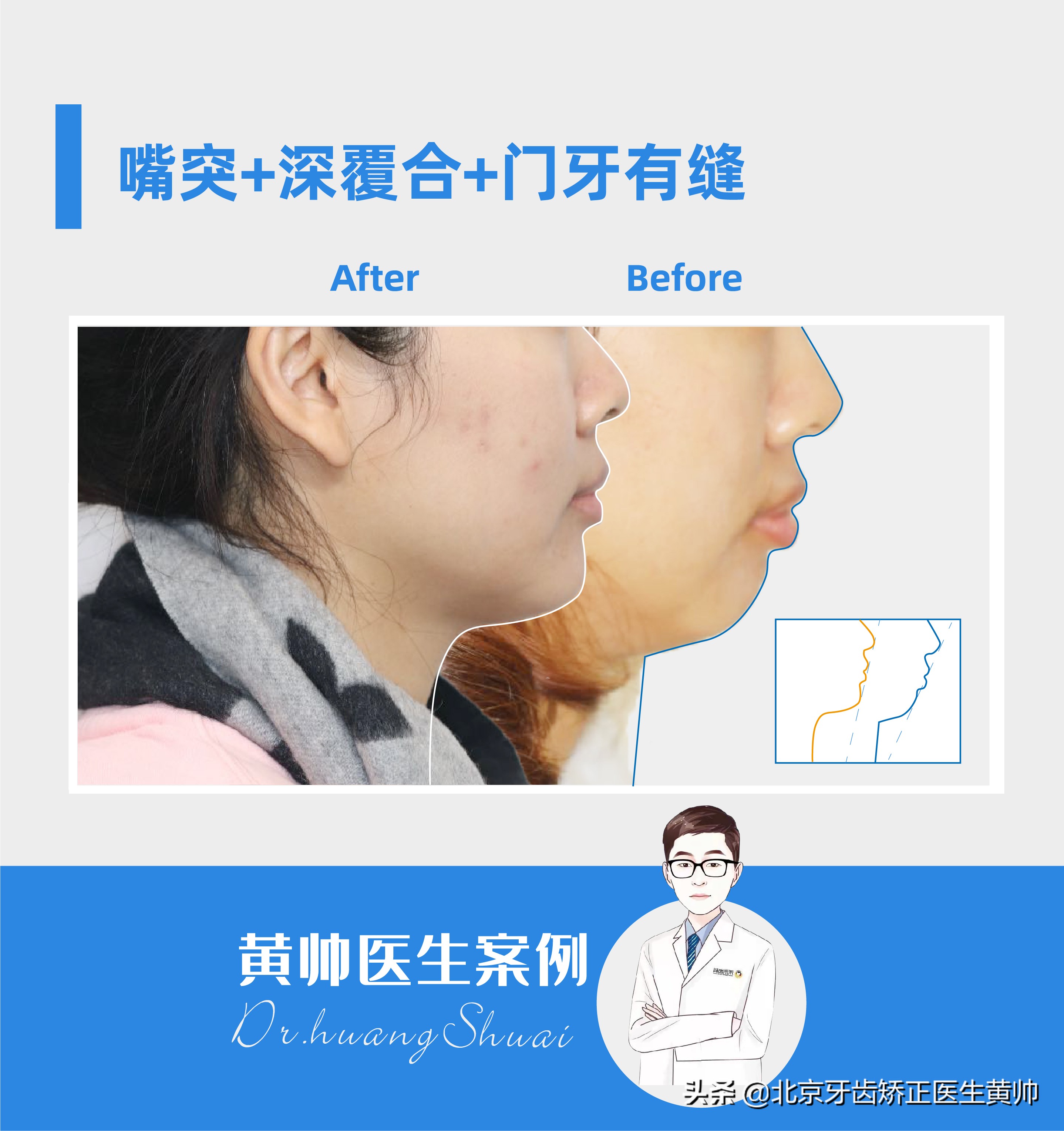 橡胶牙套矫正后脸型变化,戴过牙套的脸恢复了吗