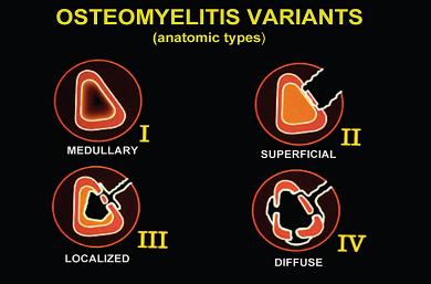 骨髓炎和慢性骨髓炎的区别,骨感染是不是就是骨髓炎