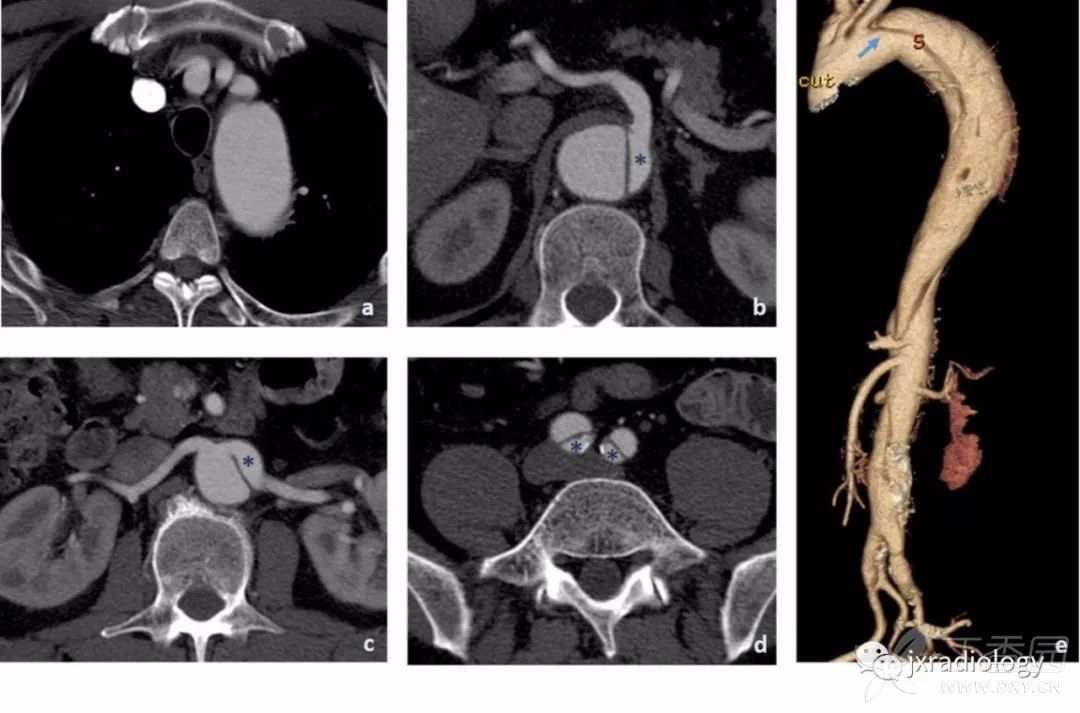 急性主动脉综合征报道,急性主动脉综合征症状