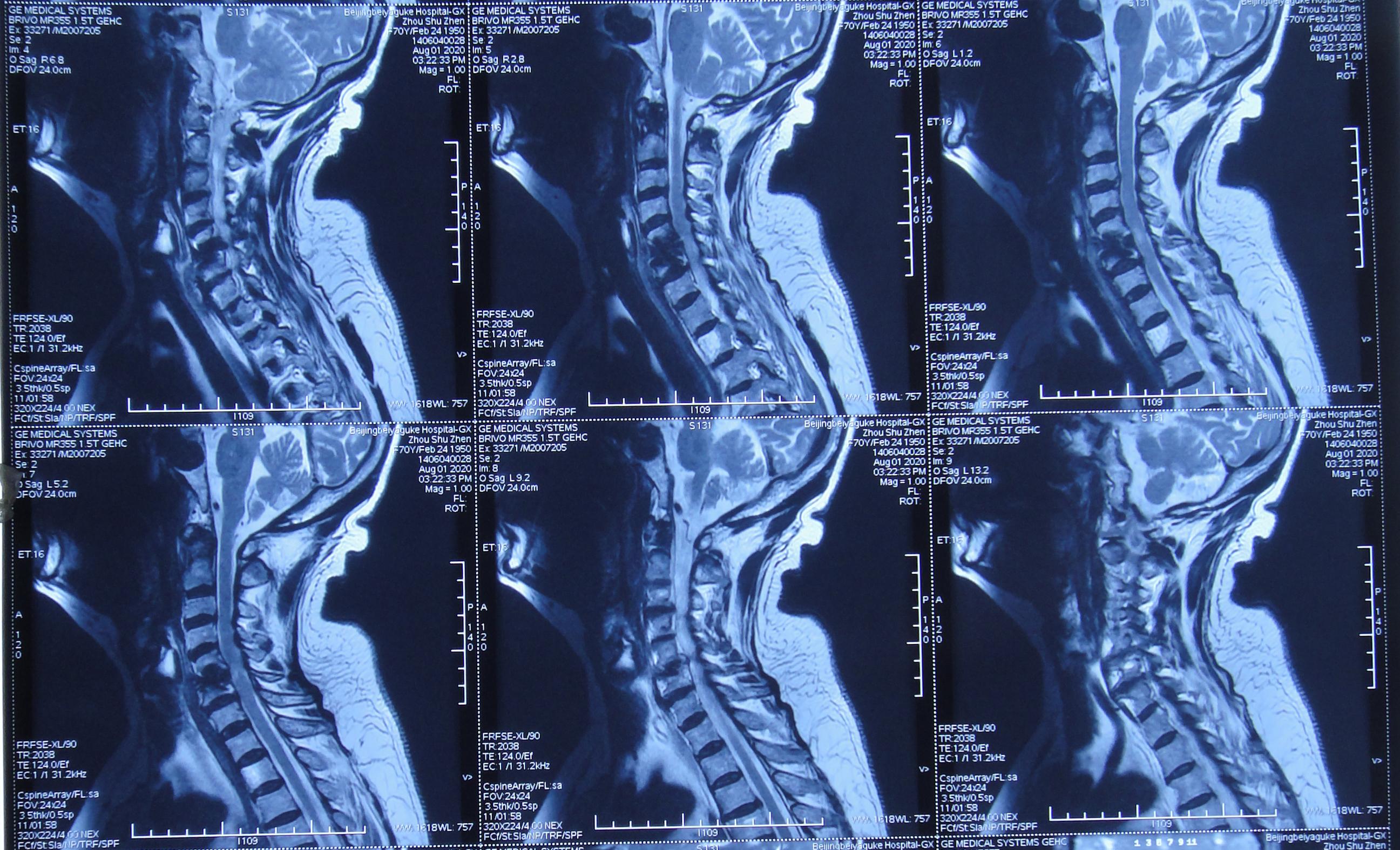 颈椎术后脑脊液漏取什么体位,脊髓型颈椎病手术后植骨愈合时间