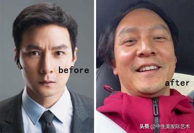 发际线最简单的补救方法,怎么有效的修复发际线