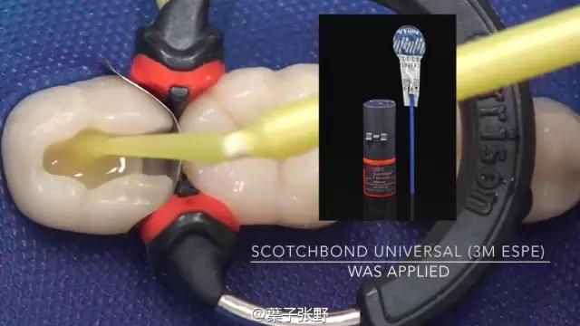 补牙疼吗补牙过程图,补牙全部过程是什么样子的