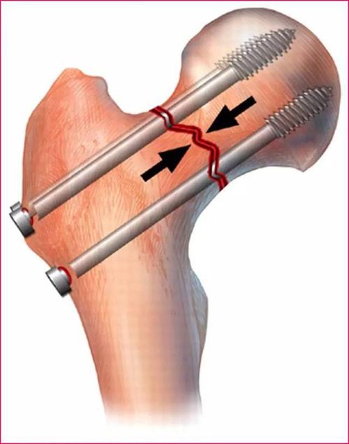 老人胯骨错位骨折不手术会好吗,怎样判断老人胯骨骨折