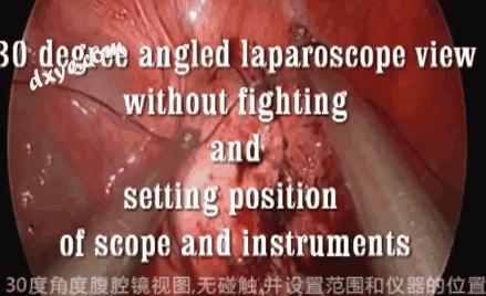 腹腔镜下打结的方法,腹腔镜推结器打结方法视频