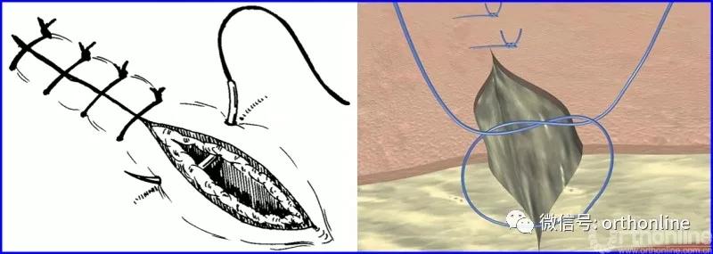 十种外科基本缝合方式详解,手术切口缝合有哪几种