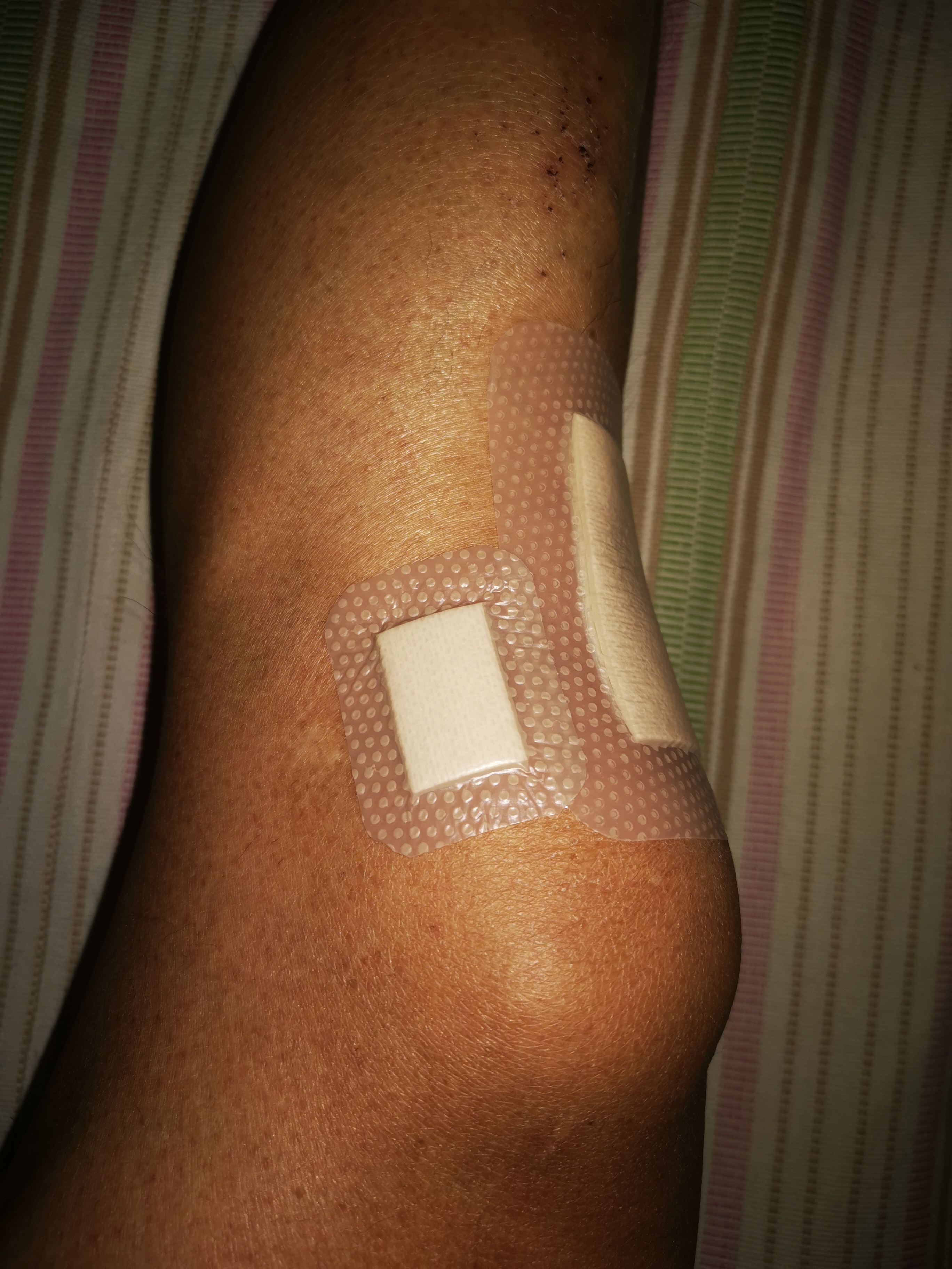 疤痕贴瑞典墨尼克术后多久用,瑞典墨尼克美皮护