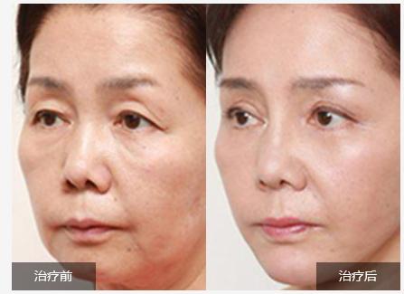 什么是热玛吉除皱术千万别入坑,什么是热玛吉整形项目