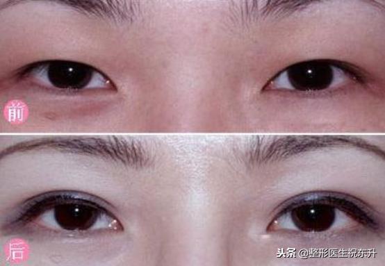 割双眼皮后怎样可以尽快完全恢复,割双眼皮的危害老了以后会怎样
