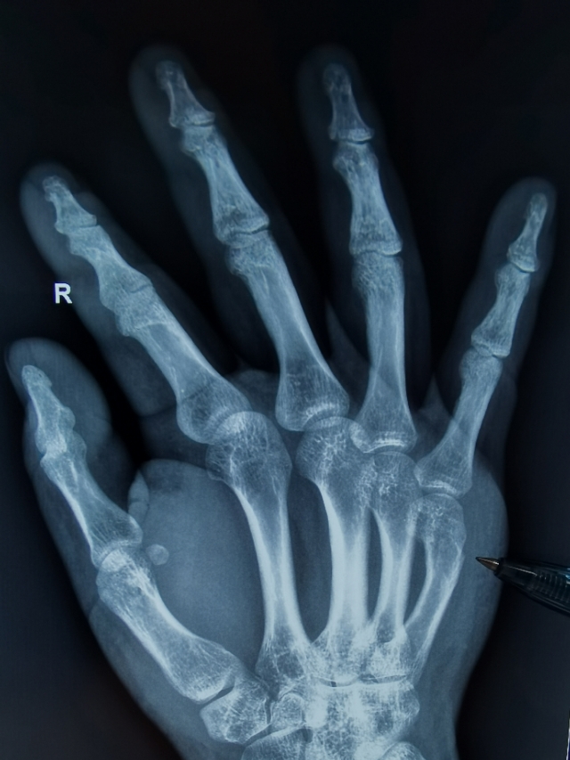 手部拳击骨折，不需要石膏固定，更不需要手术！！