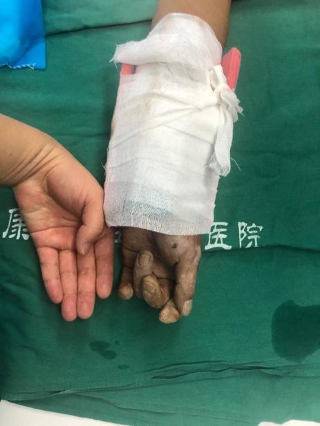 手臂离断再植,手臂断离再植