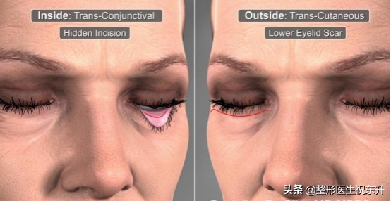 下眼皮下垂松弛可以打针吗,下眼皮睁不开是怎么回事