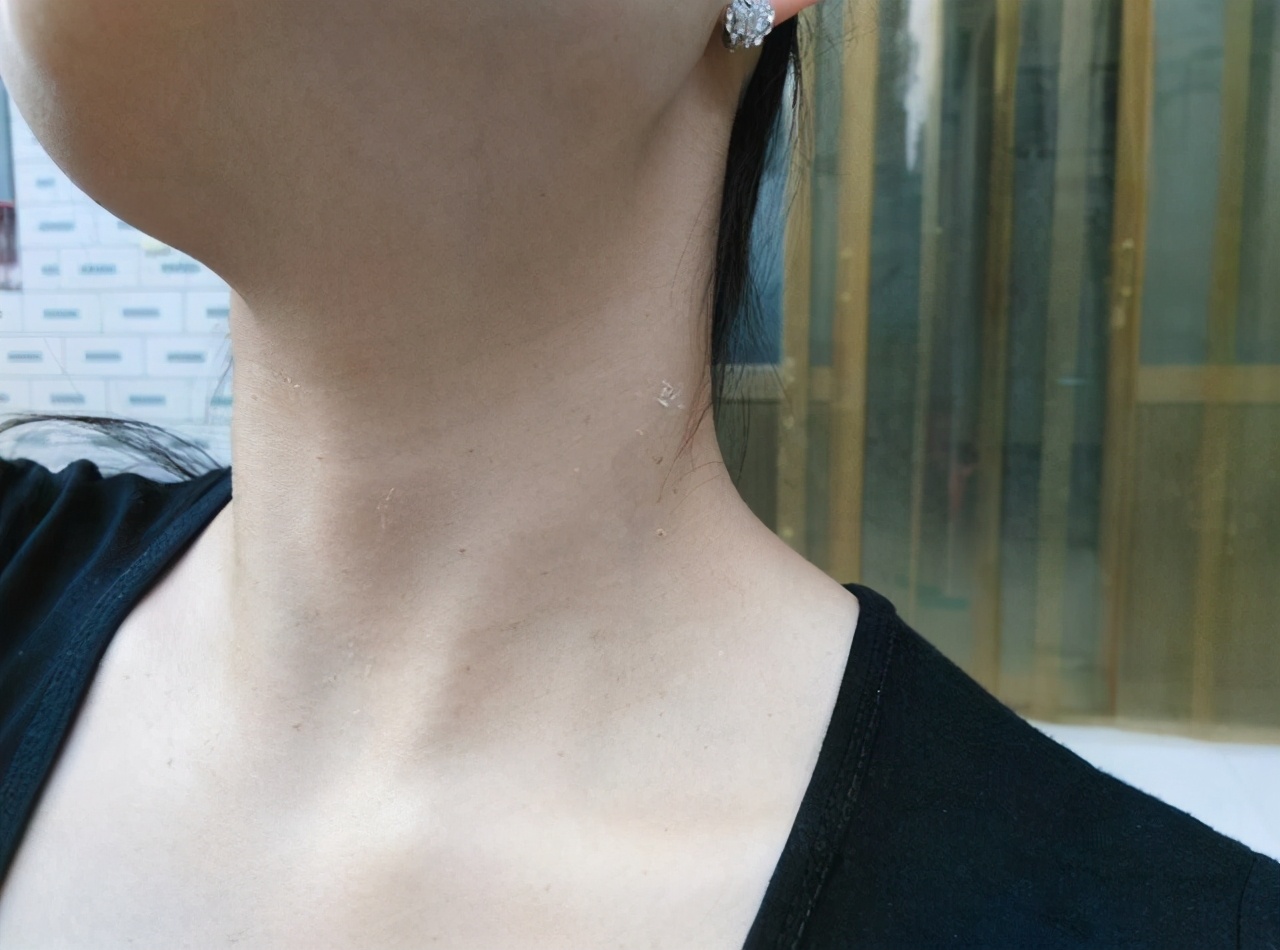 脖子腋下腹股沟长小肉粒怎么去除,腋下脖子上长小肉粒是什么原因