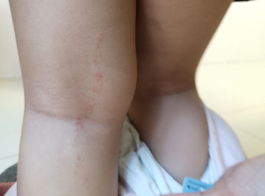 长成圆圈形状是癣还是湿疹,线状苔藓是什么原因造成的