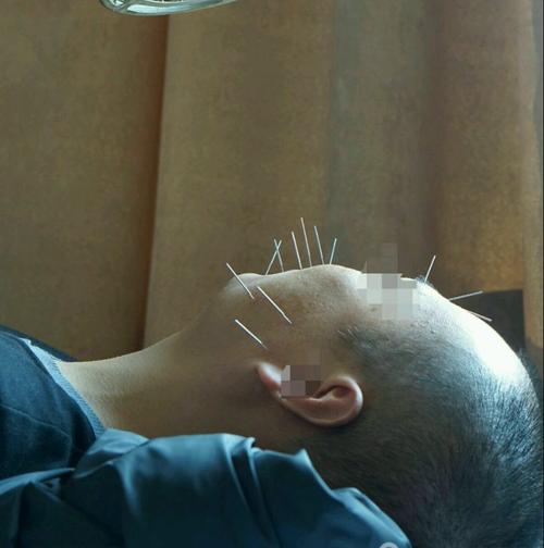 贝尔面瘫也会出现耳后不舒服吗,贝尔面瘫能完全痊愈不