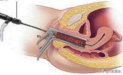 剖宫产后2年B超发现子宫里面出了“套间”,影响我要二宝吗?