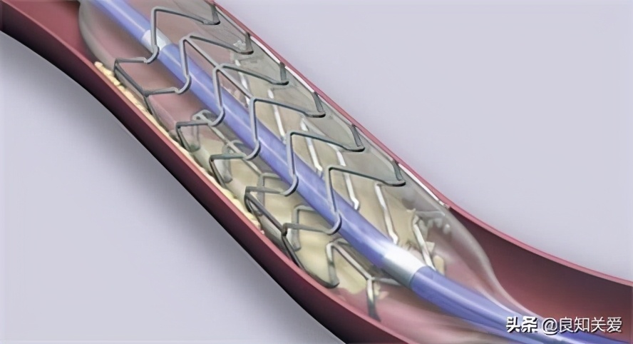 心脏支架术后感觉胸闷胸口不舒服,心脏支架术后恢复正常需多久