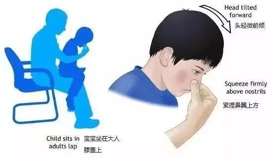 儿童白血病鼻出血症状,儿童左鼻出血警惕四种原因