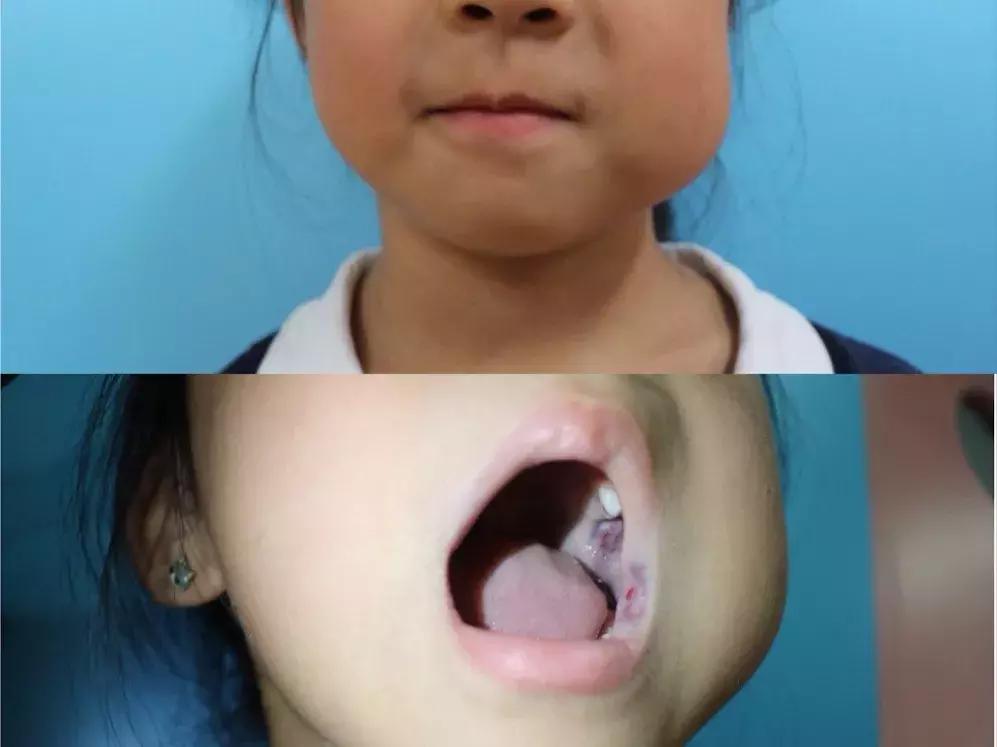 舌头下血管瘤手术多长时间,女童口腔内长巨瘤