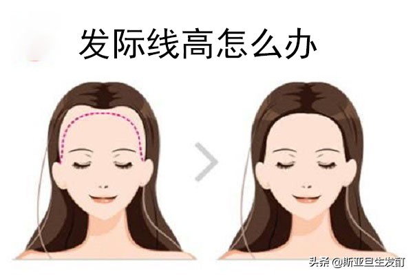 天生脑门大发际线高,天生发际线高怎么办能降下来