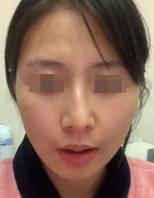 鼻子有一点歪怎么自我矫正,鼻子歪斜矫正手术多少钱