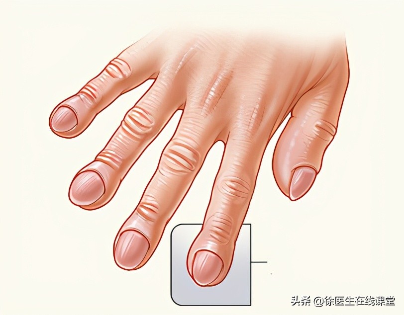 肺脓肿是局限性化脓性炎吗,急性肺脓肿与其他疾病鉴别