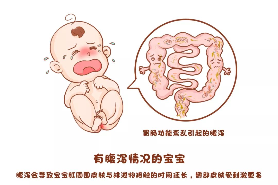 宝宝“红屁股”反反复复?别总让纸尿裤背锅,孕妈护理也有错