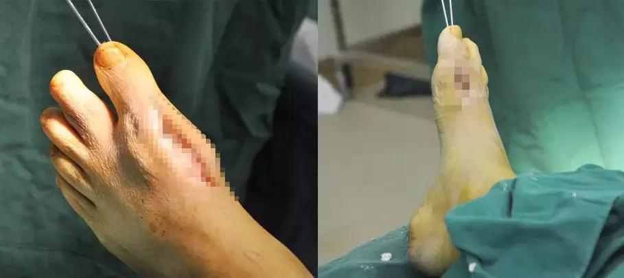 痛风脚踝有痛风石怎样才能变小,痛风石是引起痛风的根本原因吗