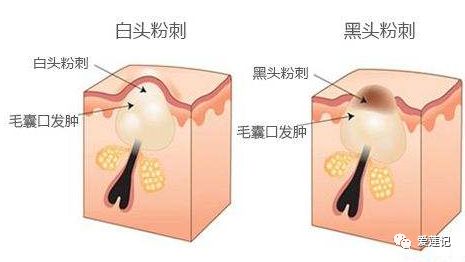 黑头挤不掉怎么办,棉签挤白头黑头