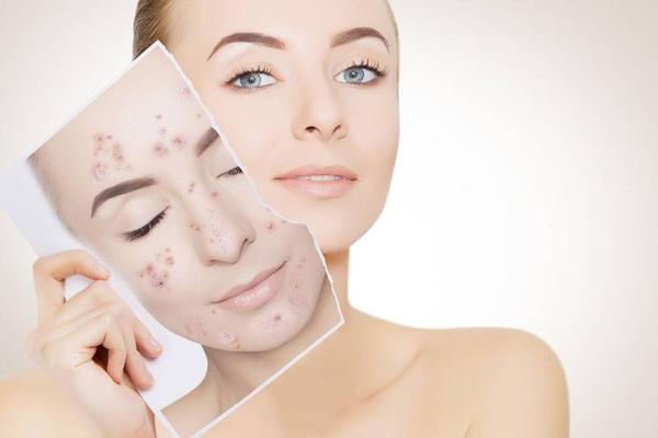 红痘印和黑痘印一起怎么去除,脸上有红痘印和黑痘印