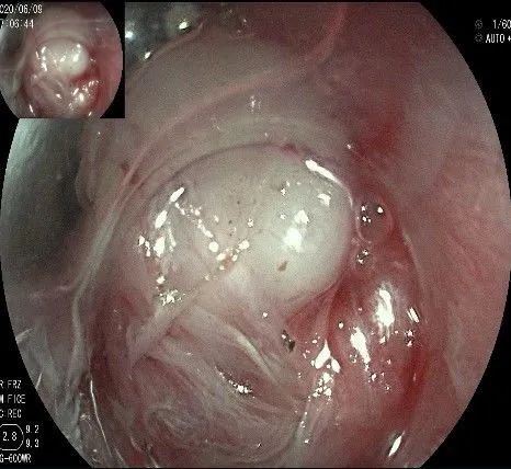 贲门处见隆起性病变,贲门高级别瘤变esd术后不能吃什么