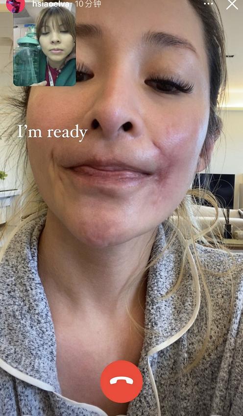 萧亚轩被狗咬左边脸还是右边脸,萧亚轩被狗咬后的恢复状态