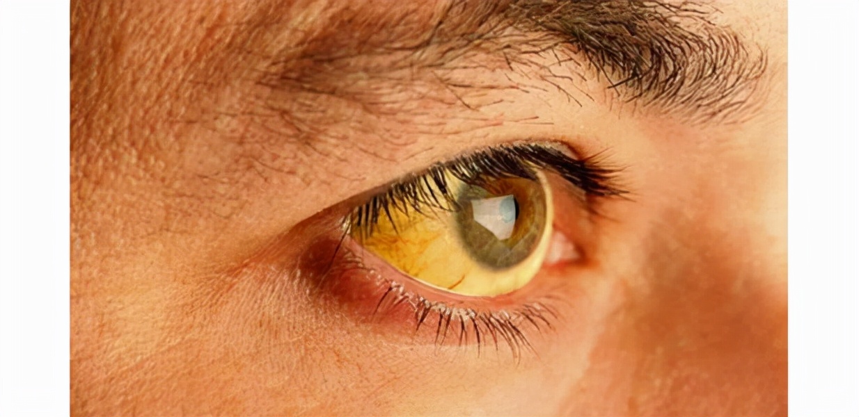 肝衰竭有治愈的希望吗,重度肝衰竭是什么原因造成的