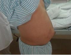 肝硬化及炎症手术的难度很大,肝硬化细胞治疗最新临床课题