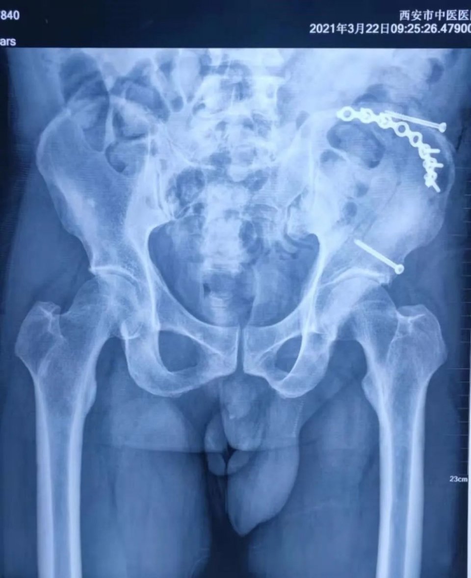 丨传承·创新丨——多学科协作奏响凶险骨折患者生命乐章