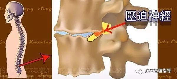 72岁老人腰疼还有骨刺该怎么治疗,老年人骨刺疼痛怎么治疗