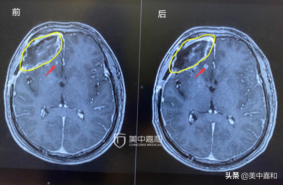 癌症术后复发怎么治疗,癌症术后发现转移怎么办