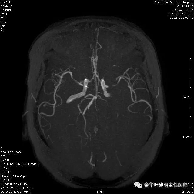左肺下叶恶性病变,左肺上叶和下叶都有血管畸形