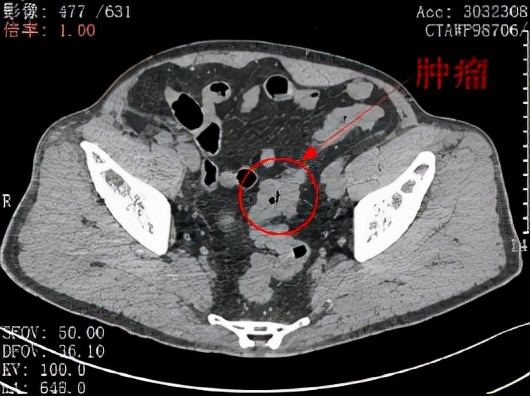北大深圳医院为肾移植后男子顺利完成手术