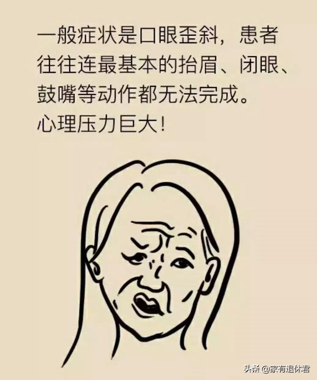 专家：冷暖交替谨防面瘫,短期面部受冷防止面瘫