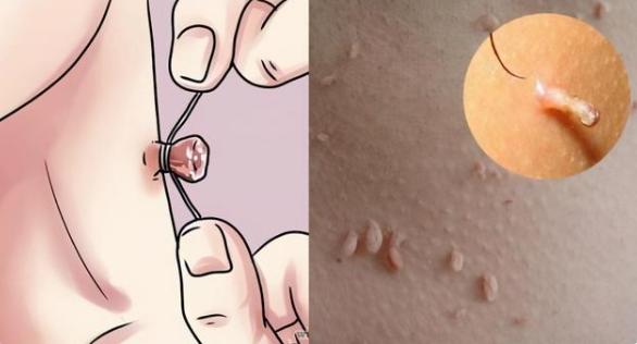 腋下脖子上长小肉粒去除方法,脖子上有小肉粒会传染给其他人吗