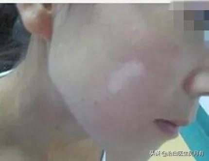 脸部白癜风早期能不能治好，初期脸上白癜风能治好吗？