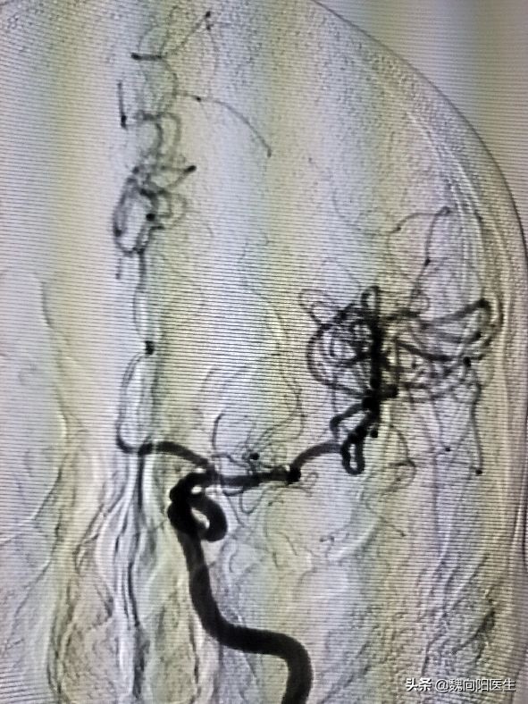 得了脑梗不敢出去怎么处理,得了脑梗不用怕生活自律是关键