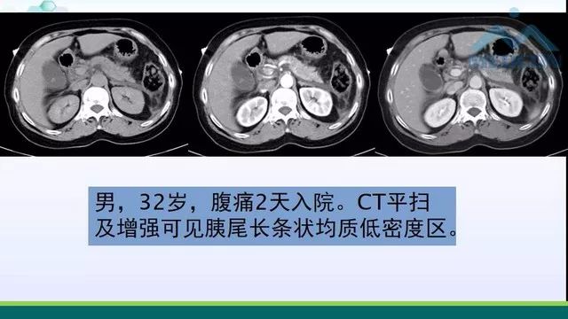 急性胰腺炎的护理措施,急性胰腺炎影像与临床