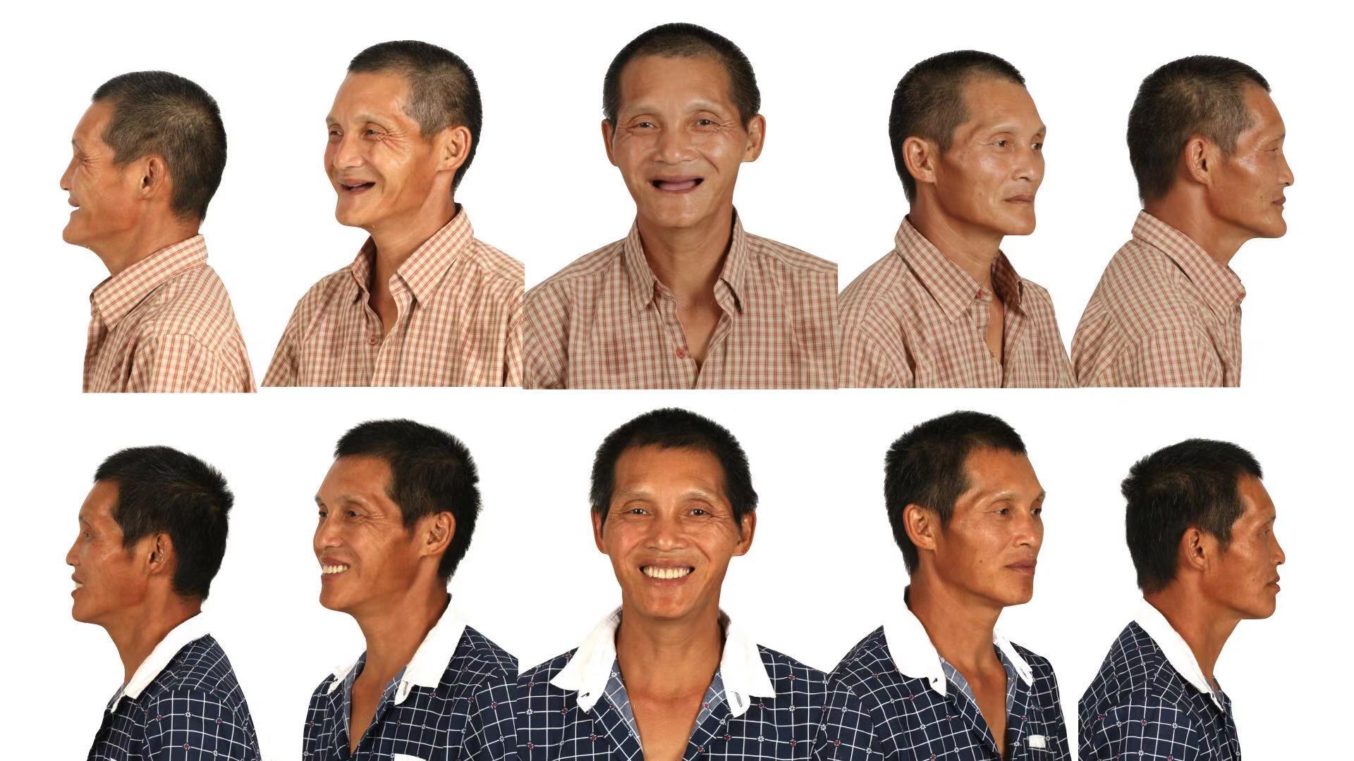 拔牙后多久可以种植牙,拔牙后多久才能种植牙