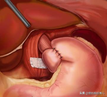 每次饭后胃胀怎么办,每次饭后胀气