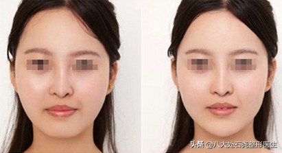 广东中医院自体脂肪填充后缩下巴,下巴自体脂肪填充需要多久