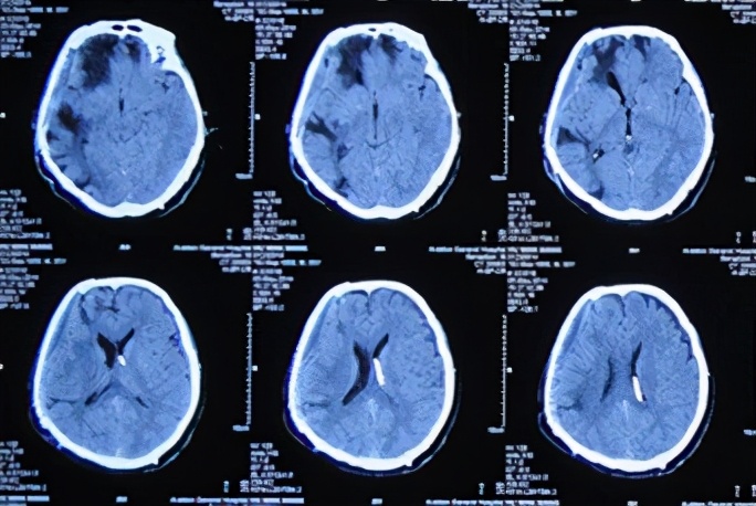 脑外伤开颅手术后脑积水,脑外伤手术后脑脊液鼻漏怎么治疗