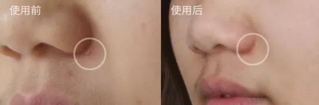 男士祛痘产品真实测评,祛痘坑修复凹洞产品测评